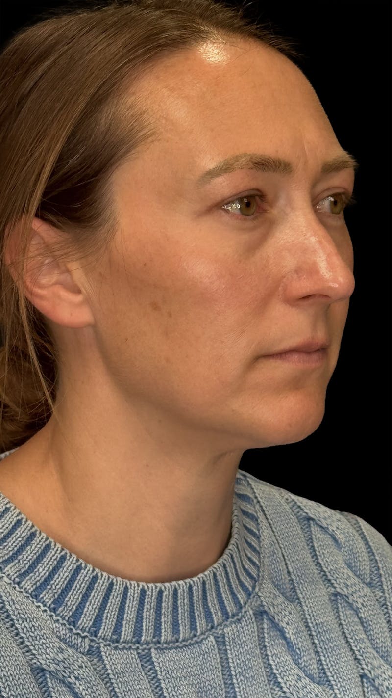 Upper Eye Rejuvenation Before & After Gallery - Patient 267655 - Image 2