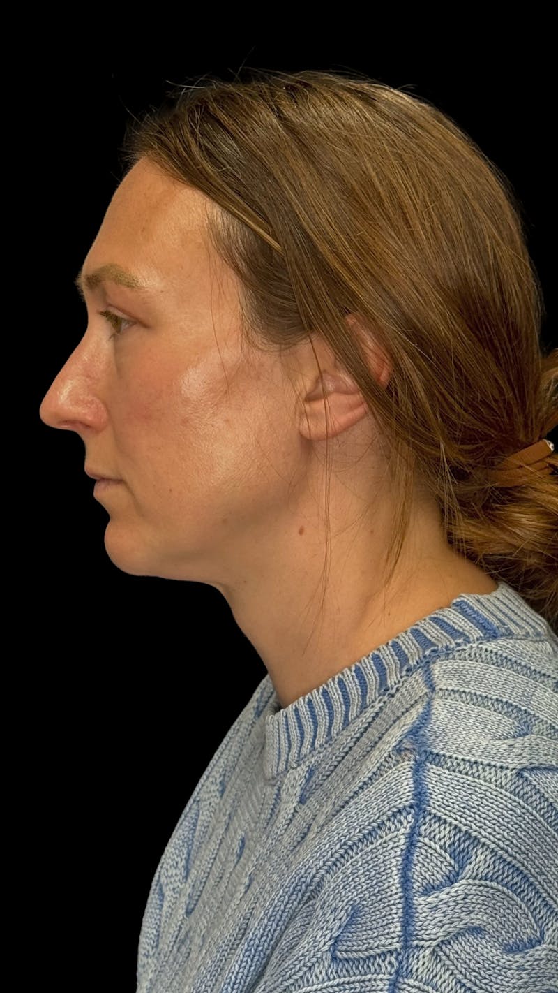Upper Eye Rejuvenation Before & After Gallery - Patient 267655 - Image 4