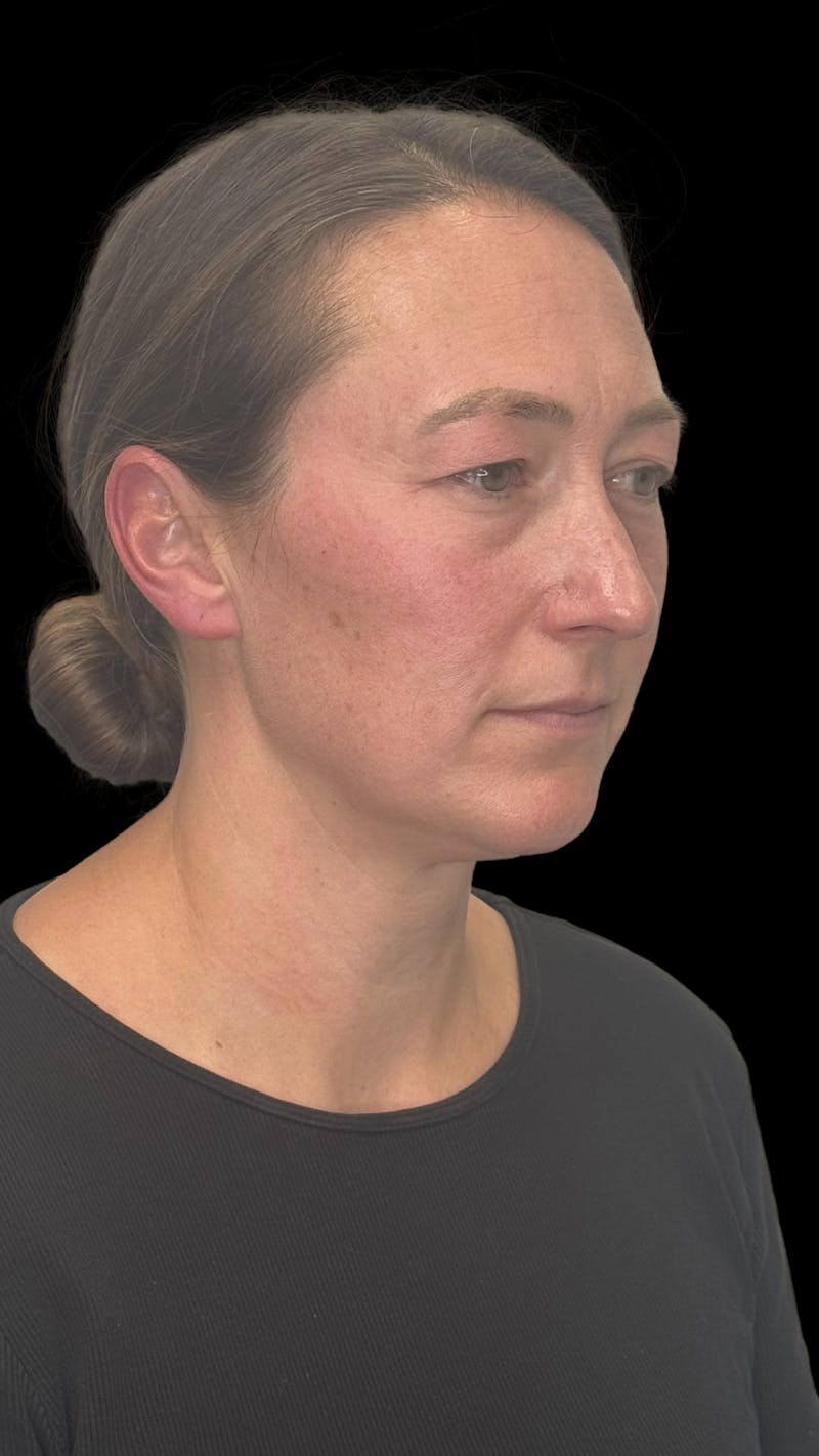 Upper Eye Rejuvenation Before & After Gallery - Patient 267655 - Image 1