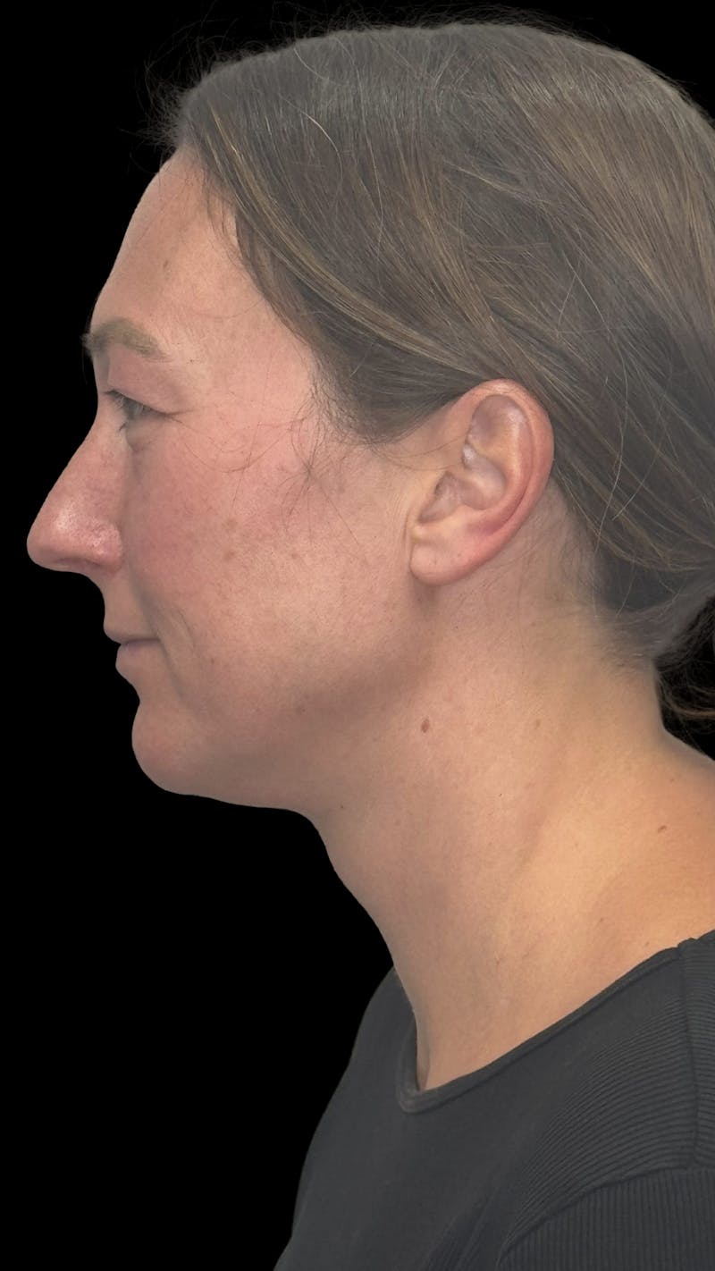 Upper Eye Rejuvenation Before & After Gallery - Patient 267655 - Image 3