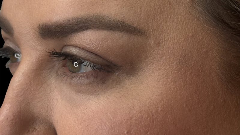 Upper Eye Rejuvenation Before & After Gallery - Patient 179840 - Image 6