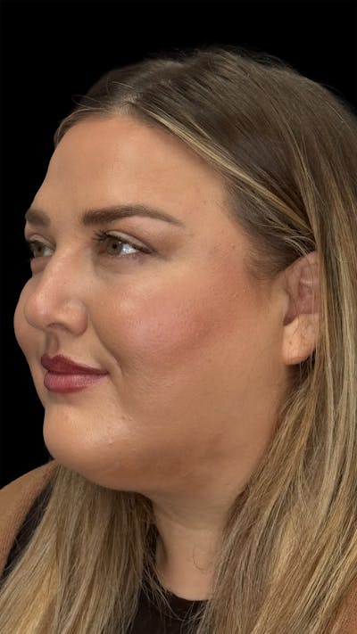 Upper Eye Rejuvenation Before & After Gallery - Patient 179840 - Image 2