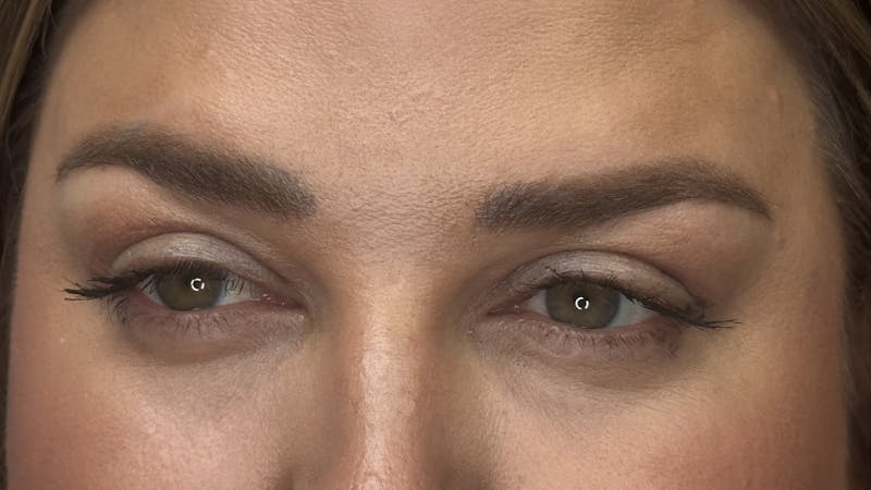 Upper Eye Rejuvenation Before & After Gallery - Patient 179840 - Image 4