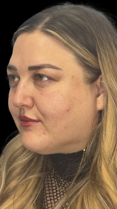 Upper Eye Rejuvenation Before & After Gallery - Patient 179840 - Image 1