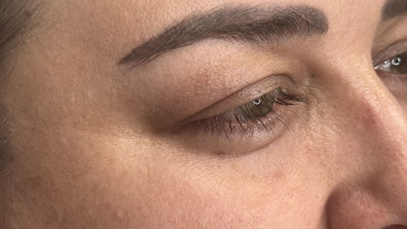 Upper Eye Rejuvenation Before & After Gallery - Patient 179840 - Image 7