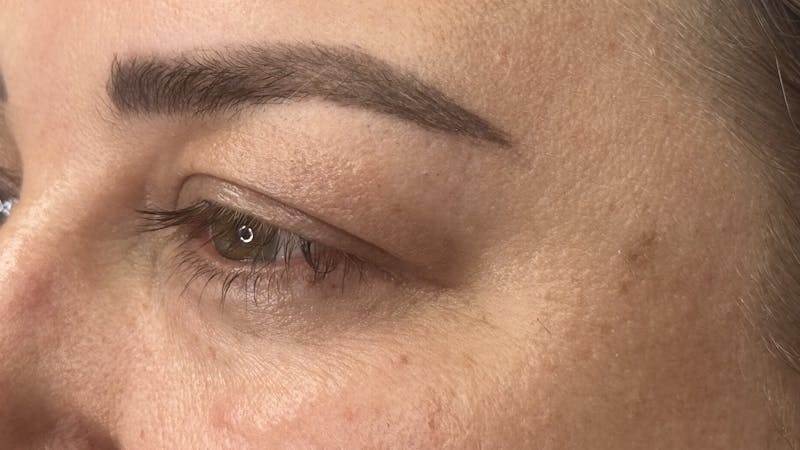 Upper Eye Rejuvenation Before & After Gallery - Patient 179840 - Image 5