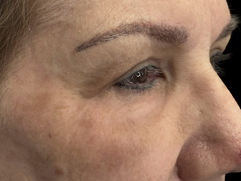 Upper Eye Rejuvenation Before & After Gallery - Patient 194034 - Image 6