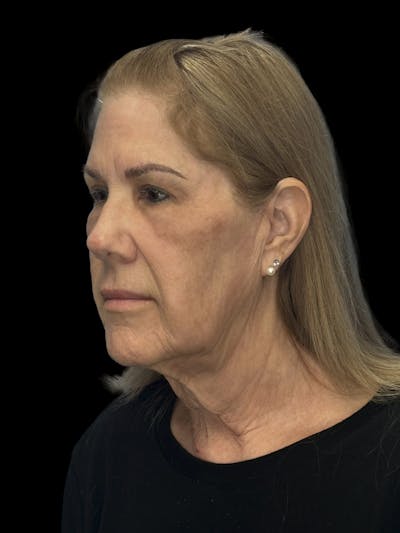 Upper Eye Rejuvenation Before & After Gallery - Patient 194034 - Image 2