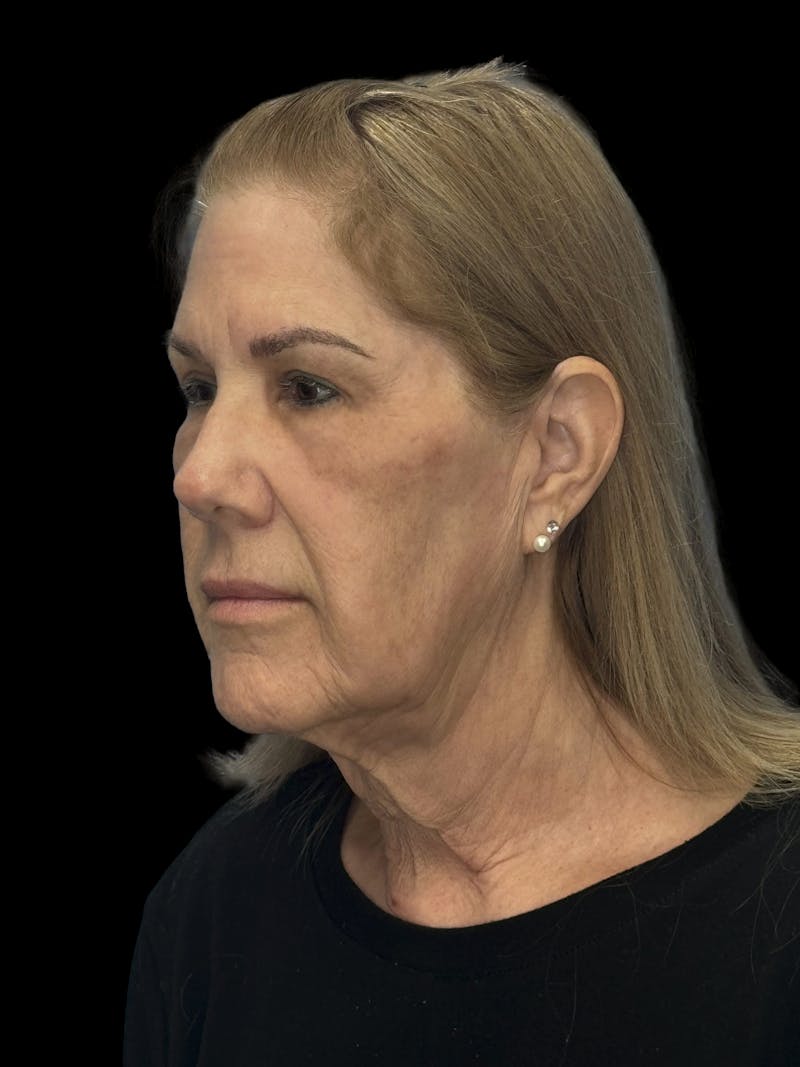 Upper Eye Rejuvenation Before & After Gallery - Patient 194034 - Image 2