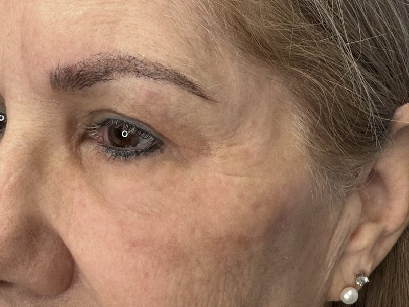 Upper Eye Rejuvenation Before & After Gallery - Patient 194034 - Image 8