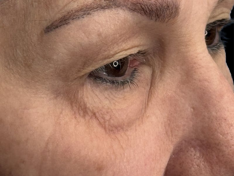 Upper Eye Rejuvenation Before & After Gallery - Patient 194034 - Image 5