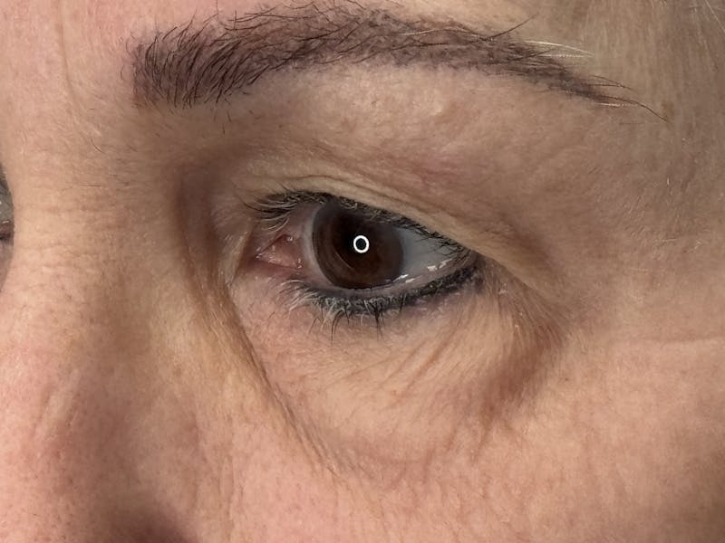 Upper Eye Rejuvenation Before & After Gallery - Patient 194034 - Image 7