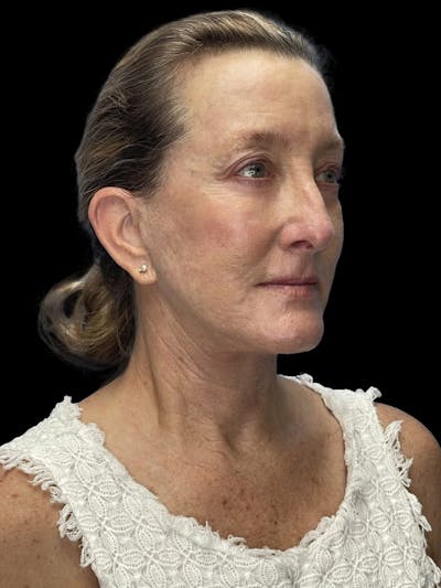 Revision Facelift Before & After Gallery - Patient 855067 - Image 2