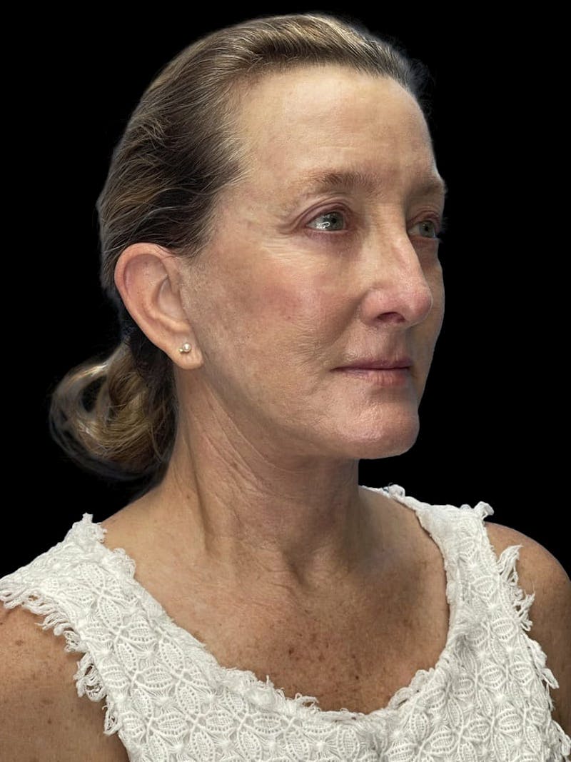Revision Facelift Before & After Gallery - Patient 855067 - Image 2
