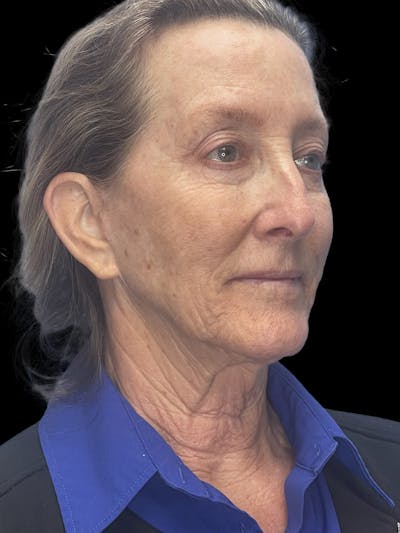 Revision Facelift Before & After Gallery - Patient 855067 - Image 1