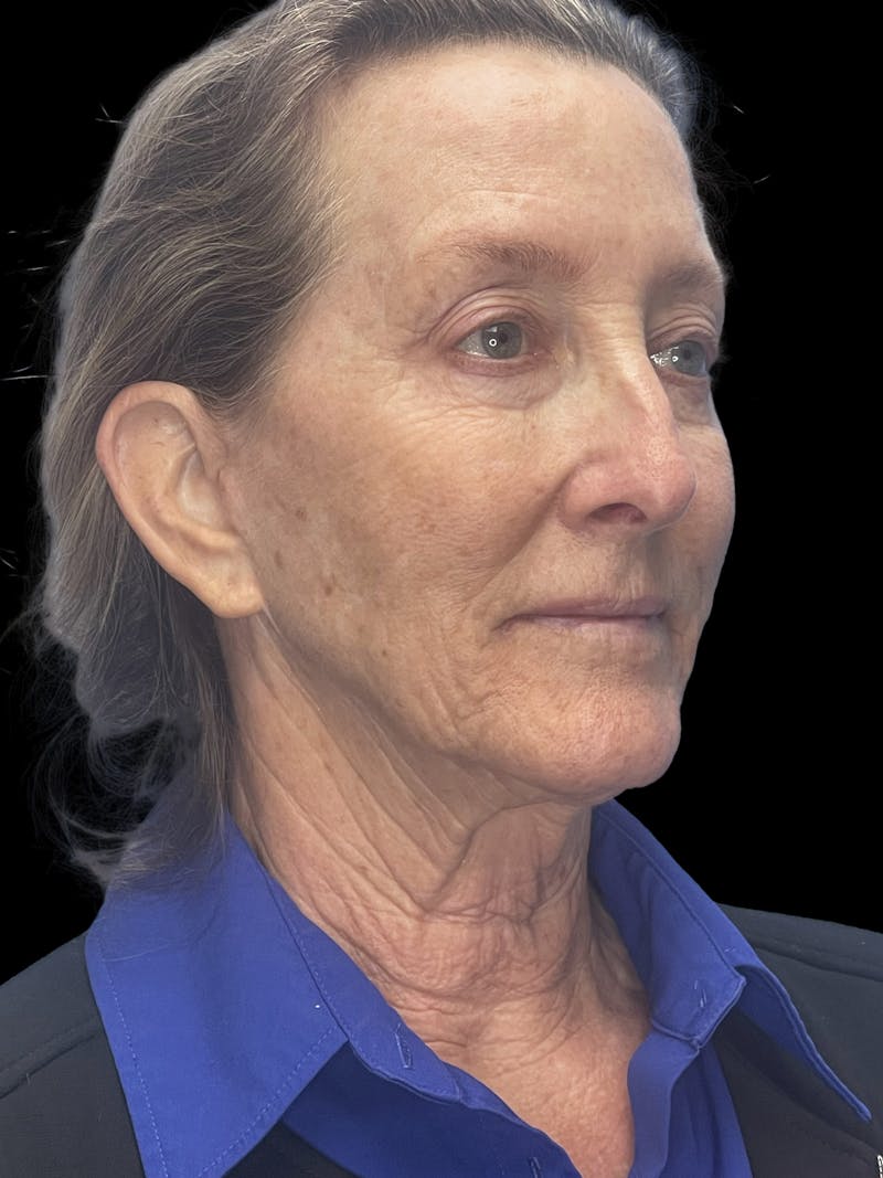 Revision Facelift Before & After Gallery - Patient 855067 - Image 1