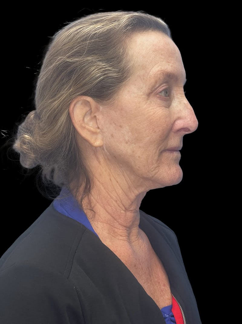 Revision Facelift Before & After Gallery - Patient 855067 - Image 7