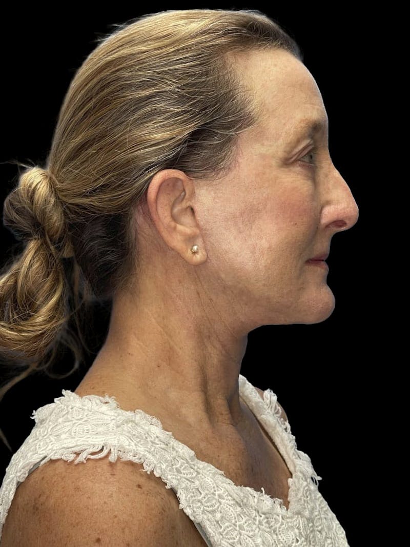 Revision Facelift Before & After Gallery - Patient 855067 - Image 8