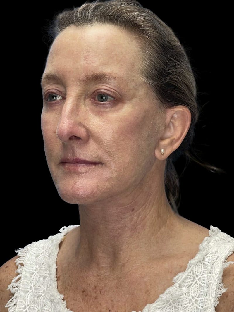 Revision Facelift Before & After Gallery - Patient 855067 - Image 10