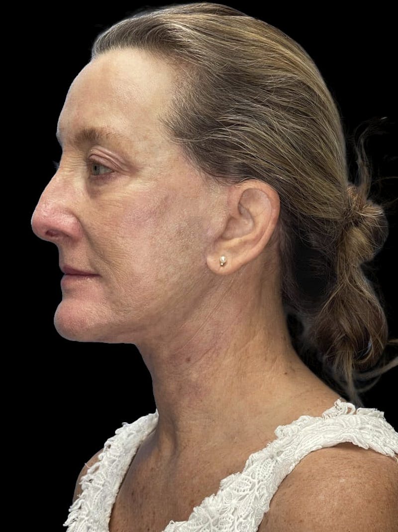 Revision Facelift Before & After Gallery - Patient 855067 - Image 6
