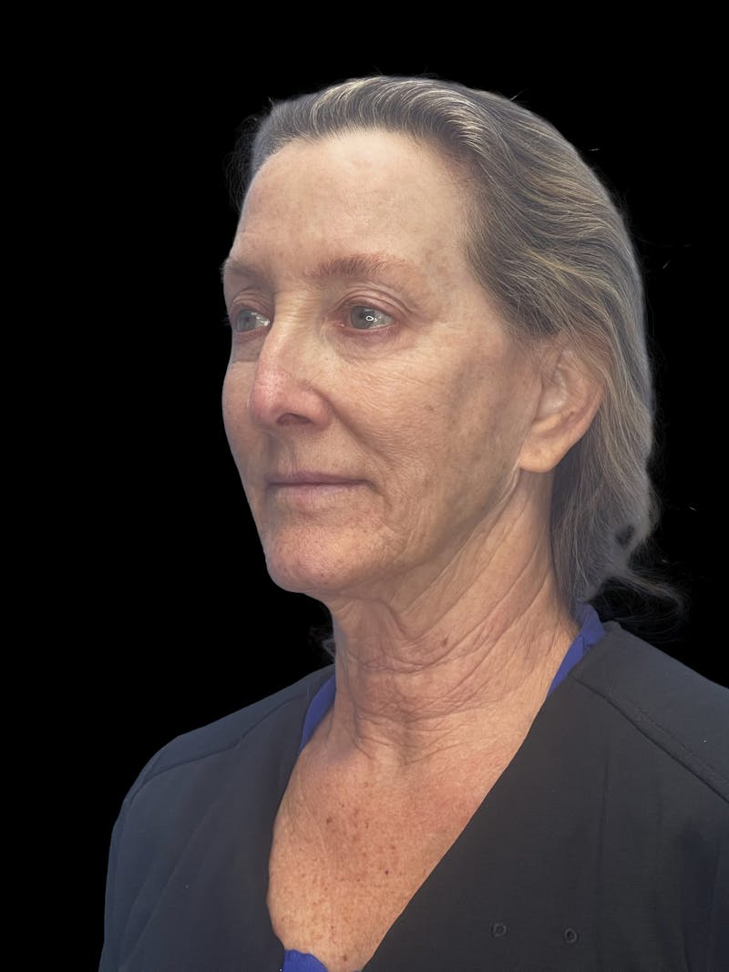 Revision Facelift Before & After Gallery - Patient 855067 - Image 9