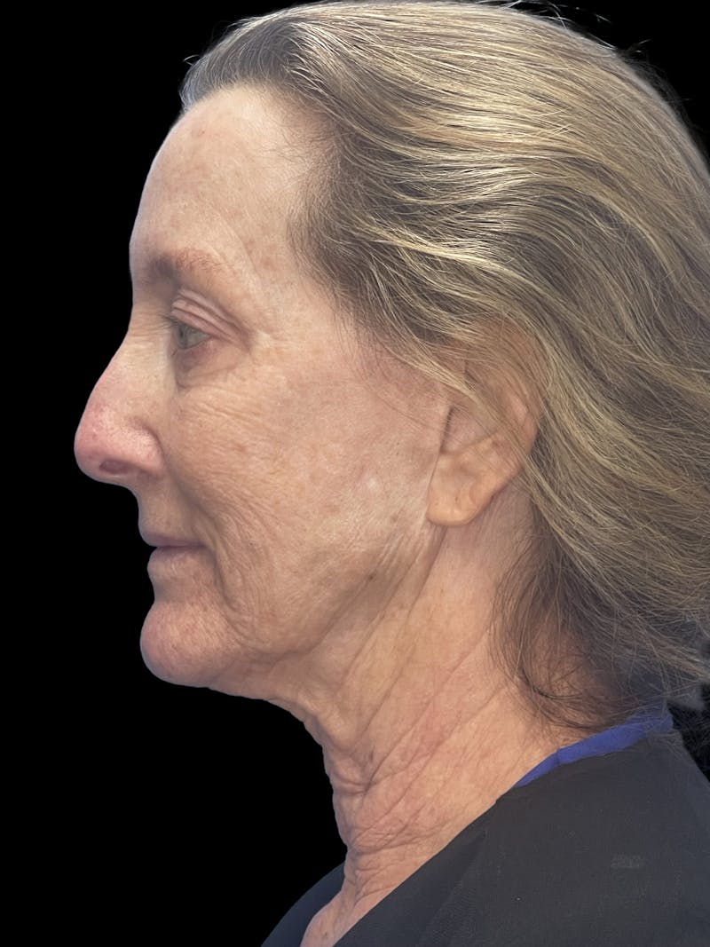 Revision Facelift Before & After Gallery - Patient 855067 - Image 5