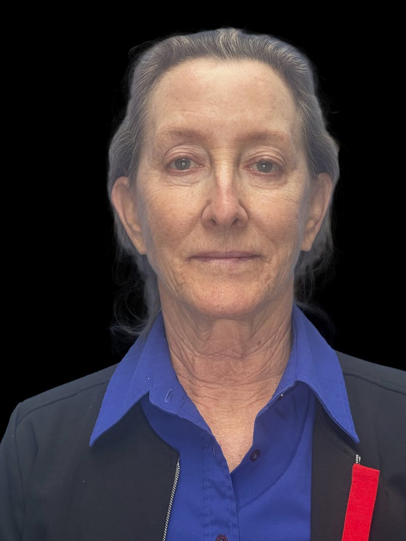 Revision Facelift Before & After Gallery - Patient 855067 - Image 3