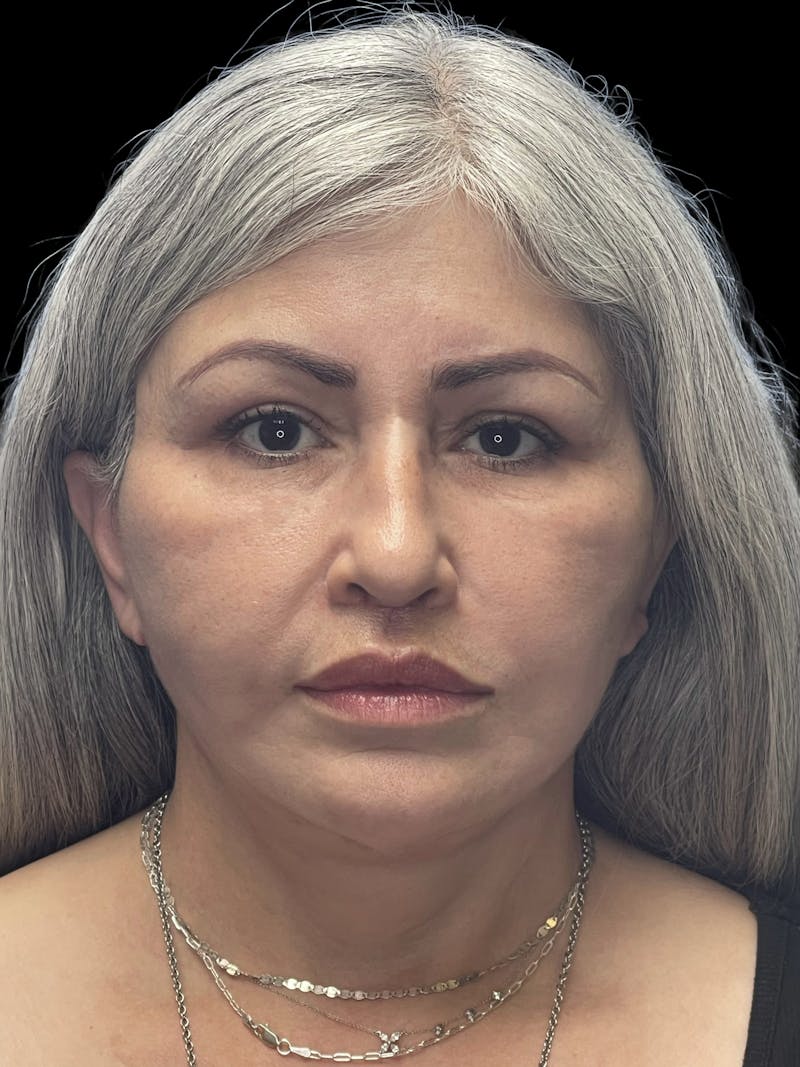 Revision Facelift Before & After Gallery - Patient 582046 - Image 6