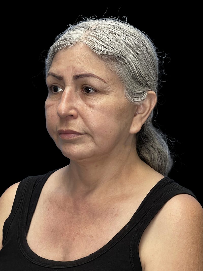 Revision Facelift Before & After Gallery - Patient 582046 - Image 3