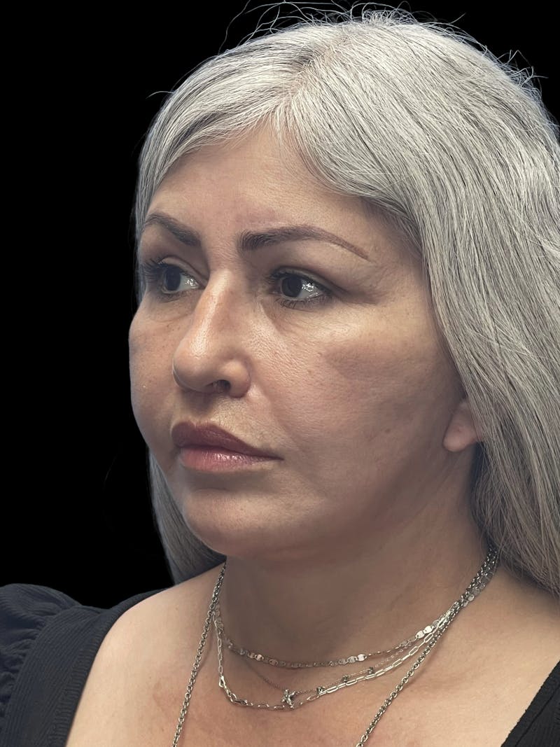 Revision Facelift Before & After Gallery - Patient 582046 - Image 4