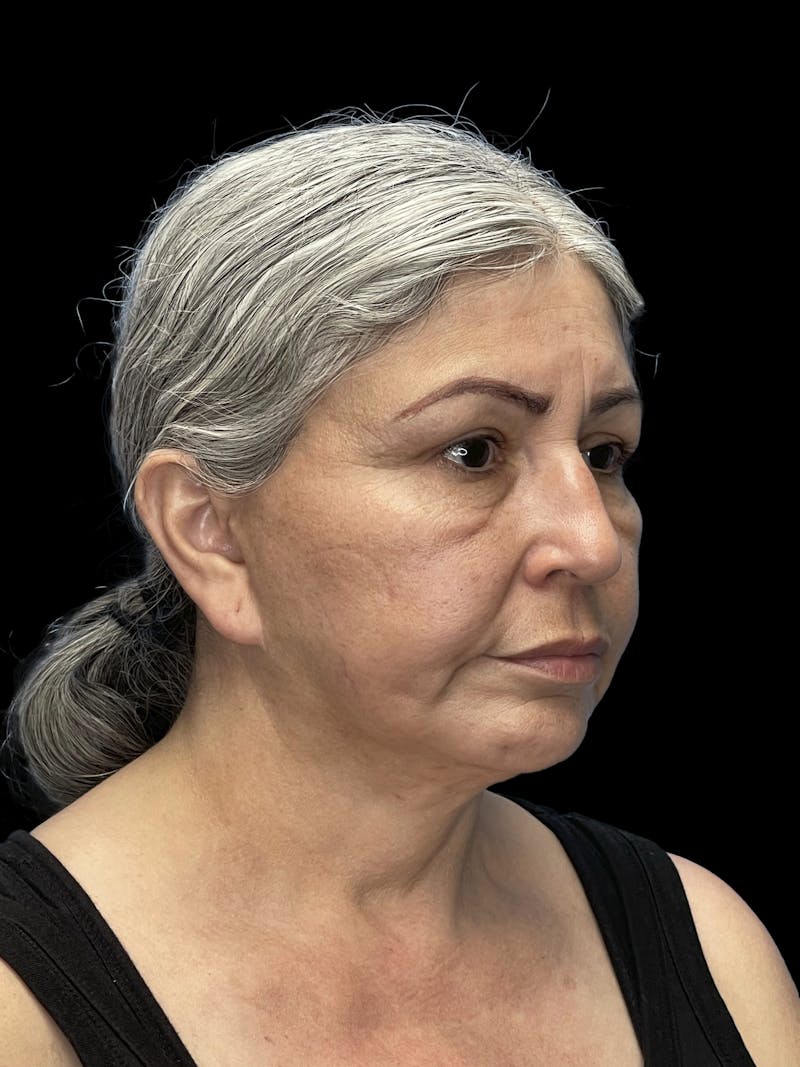 Revision Facelift Before & After Gallery - Patient 582046 - Image 1