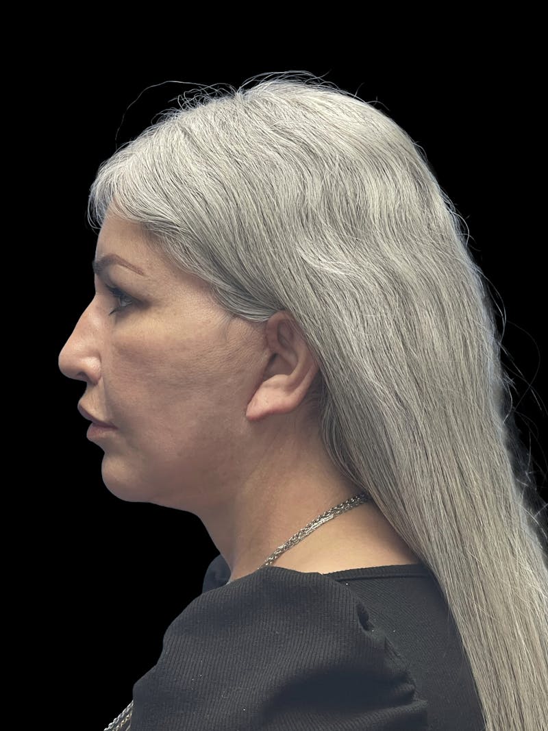 Revision Facelift Before & After Gallery - Patient 582046 - Image 10