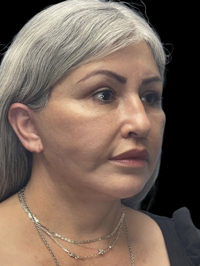 Revision Facelift Before & After Gallery - Patient 582046 - Image 2