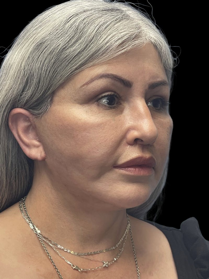 Revision Facelift Before & After Gallery - Patient 582046 - Image 2