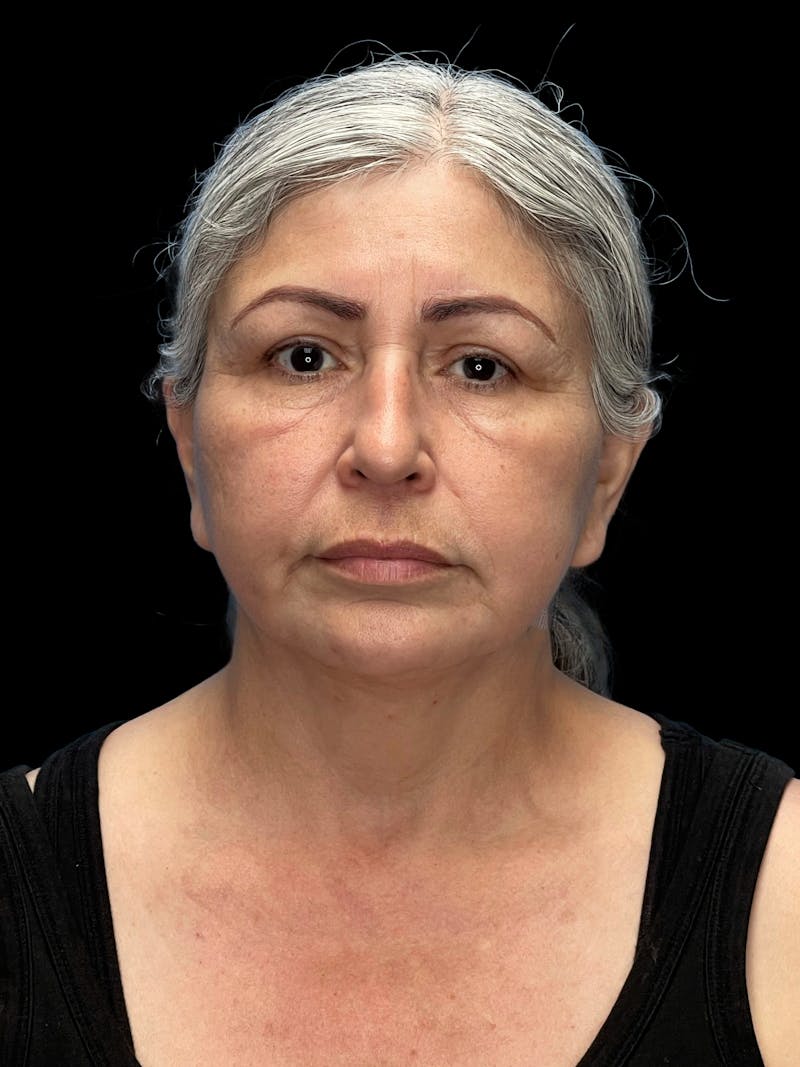 Revision Facelift Before & After Gallery - Patient 582046 - Image 5