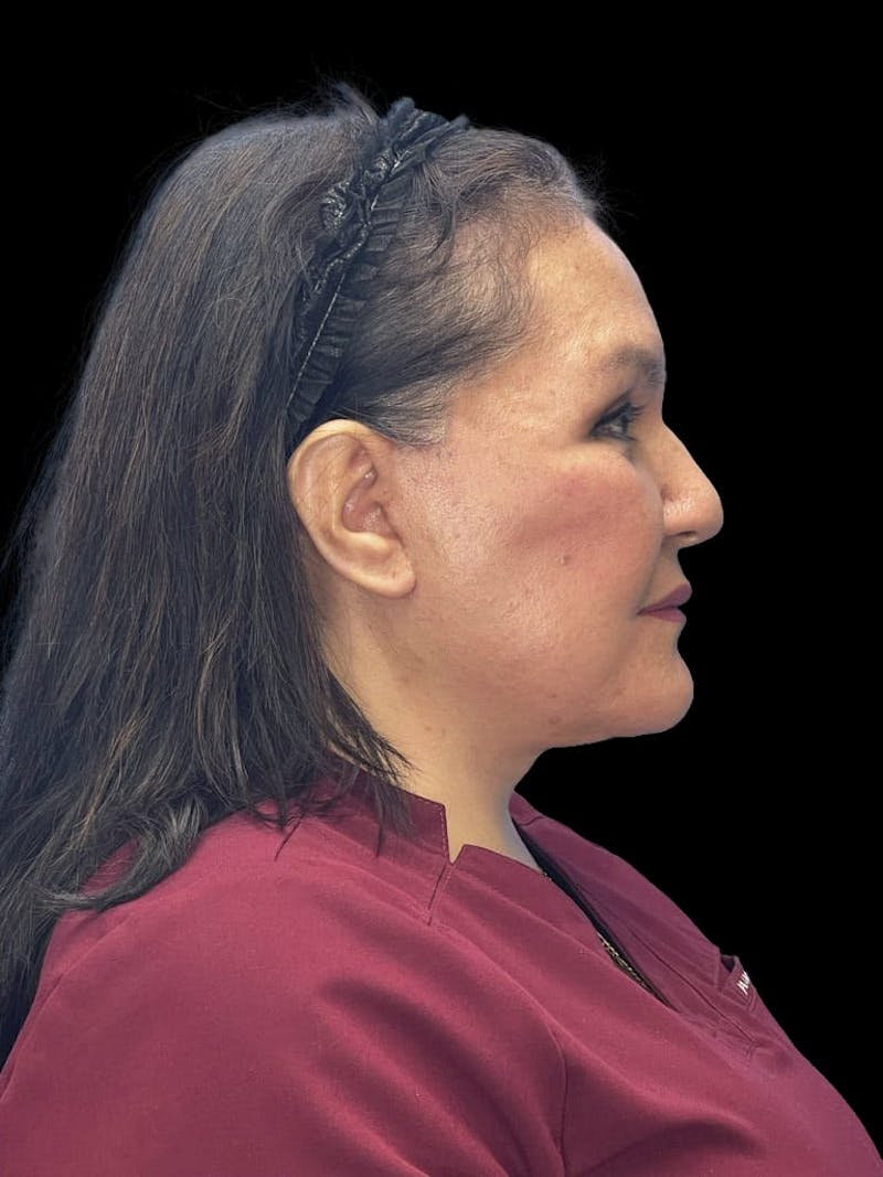 Revision Facelift Before & After Gallery - Patient 558634 - Image 6