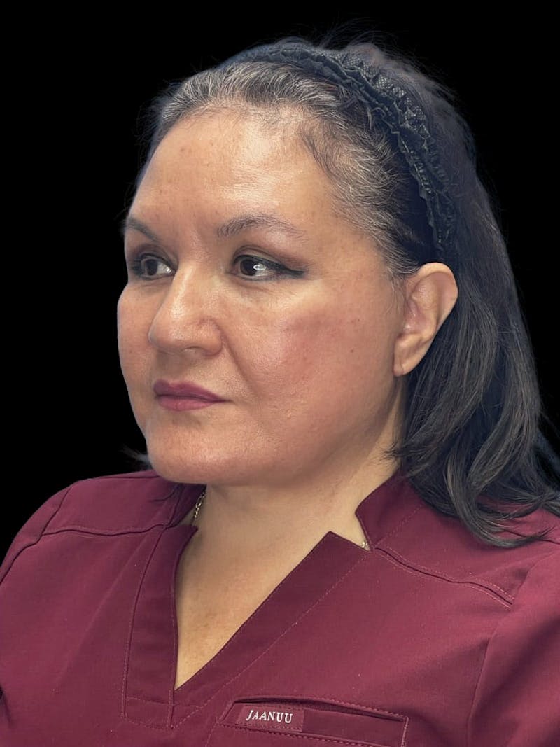 Revision Facelift Before & After Gallery - Patient 558634 - Image 8
