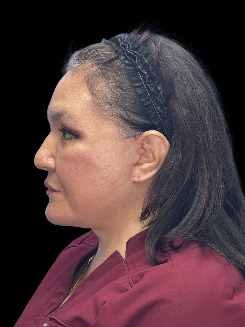 Revision Facelift Before & After Gallery - Patient 558634 - Image 10