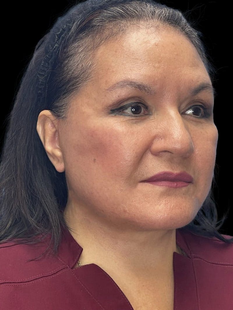Revision Facelift Before & After Gallery - Patient 558634 - Image 2