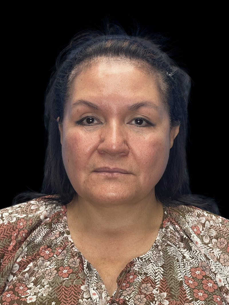 Revision Facelift Before & After Gallery - Patient 558634 - Image 3