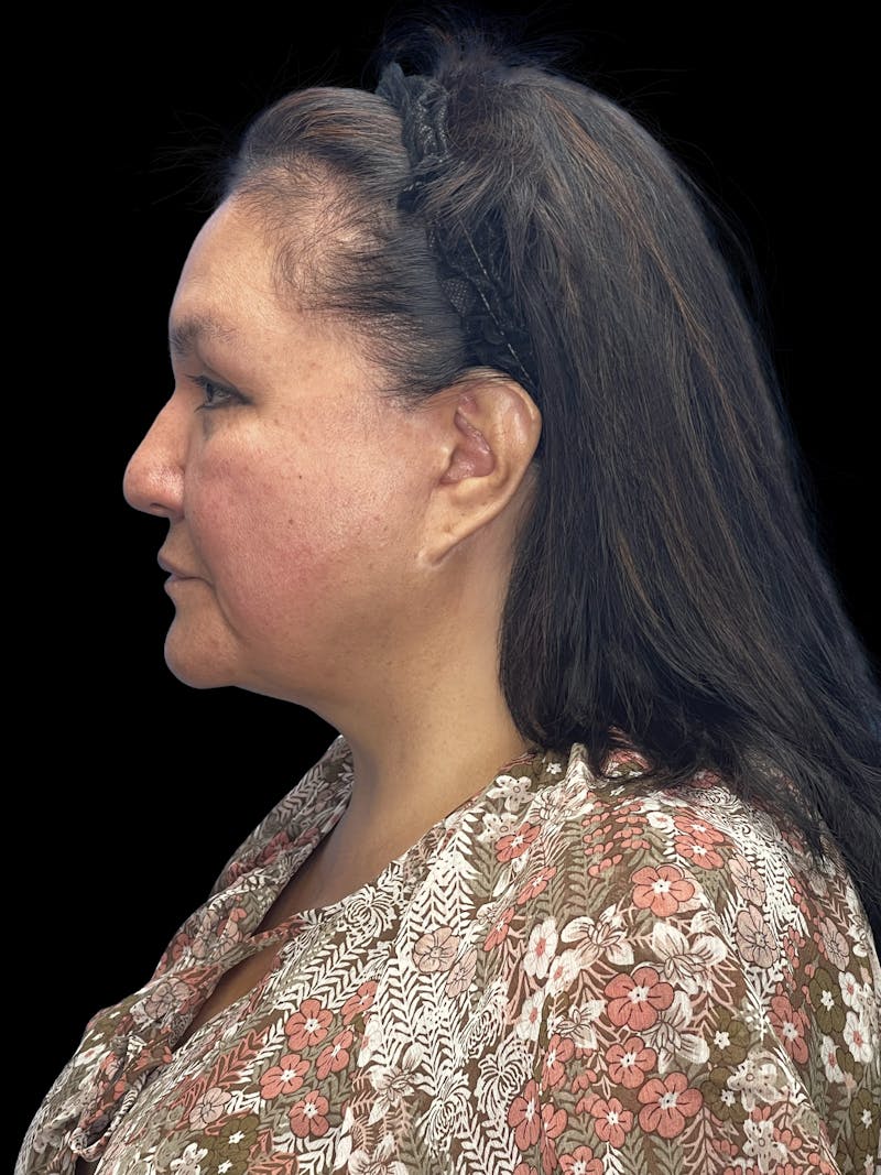 Revision Facelift Before & After Gallery - Patient 558634 - Image 9