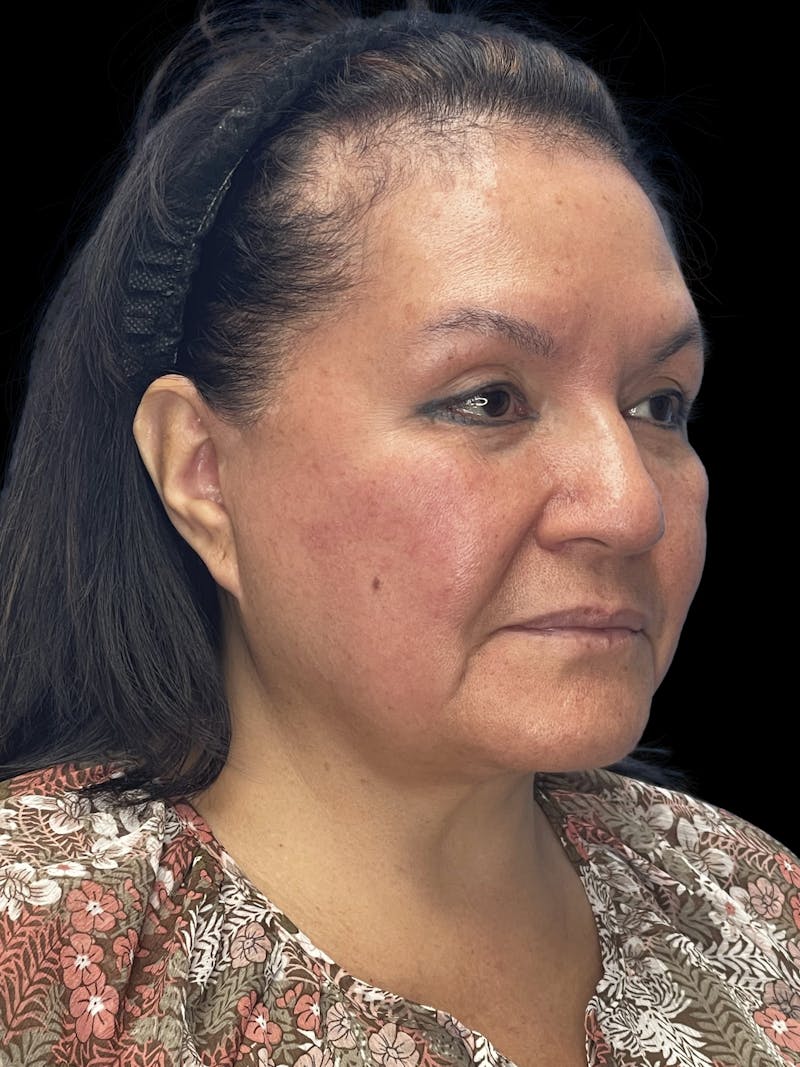 Revision Facelift Before & After Gallery - Patient 558634 - Image 1