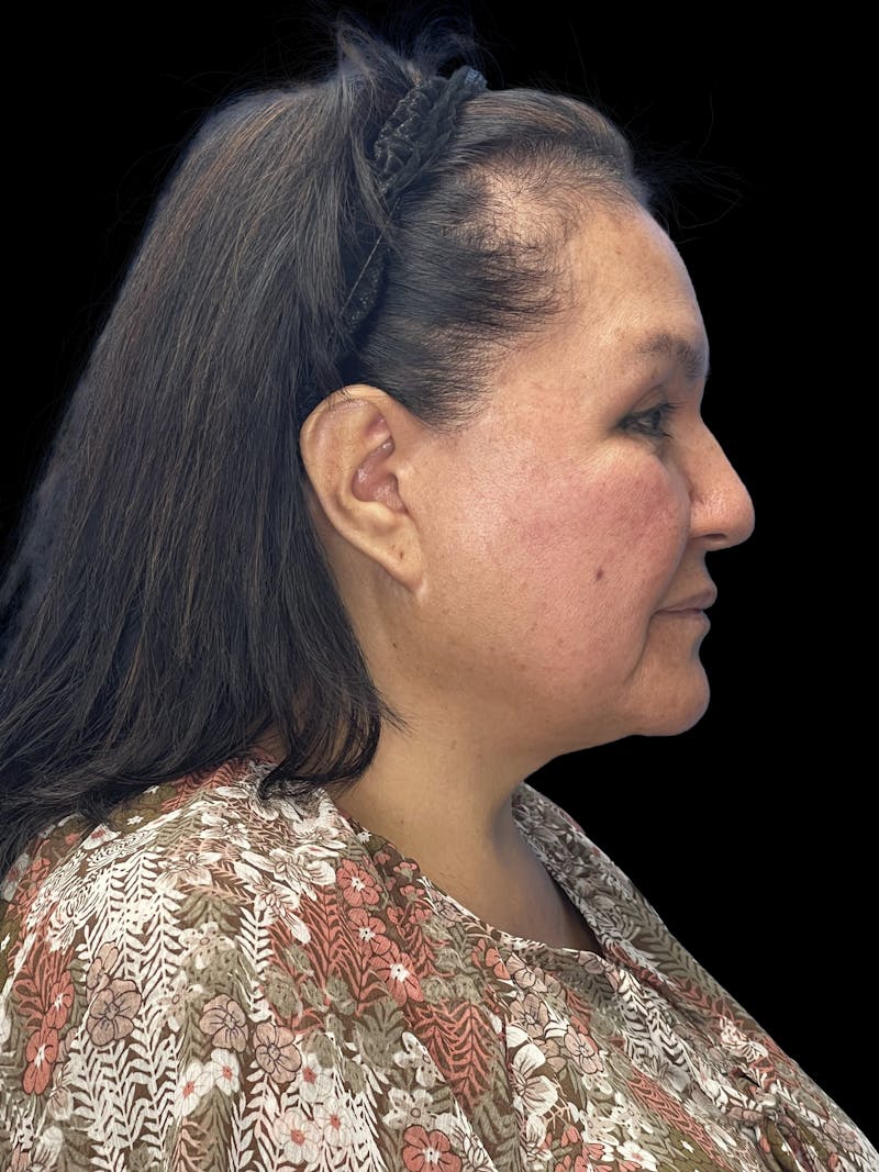Revision Facelift Before & After Gallery - Patient 558634 - Image 5