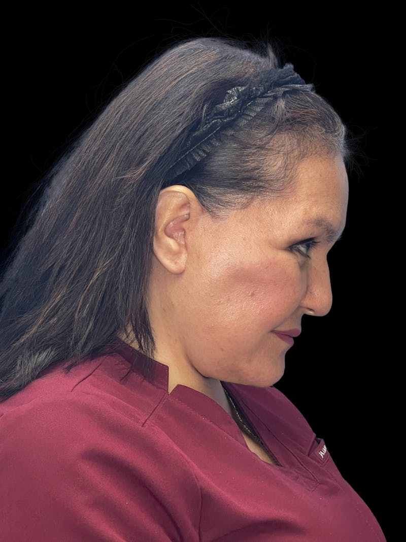 Revision Facelift Before & After Gallery - Patient 558634 - Image 12