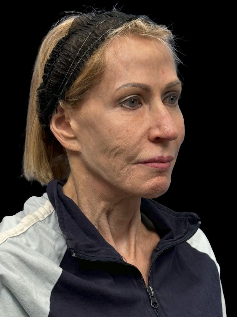 Revision Facelift Before & After Gallery - Patient 974023 - Image 1