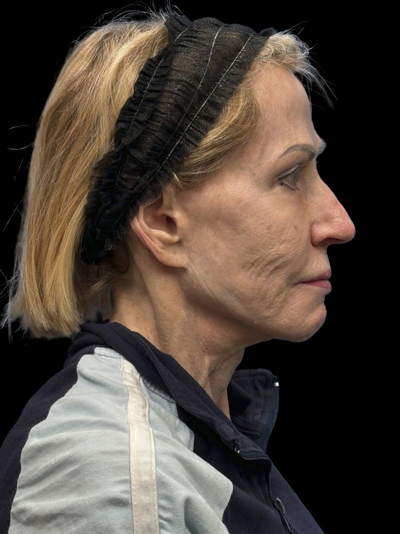 Revision Facelift Before & After Gallery - Patient 974023 - Image 9