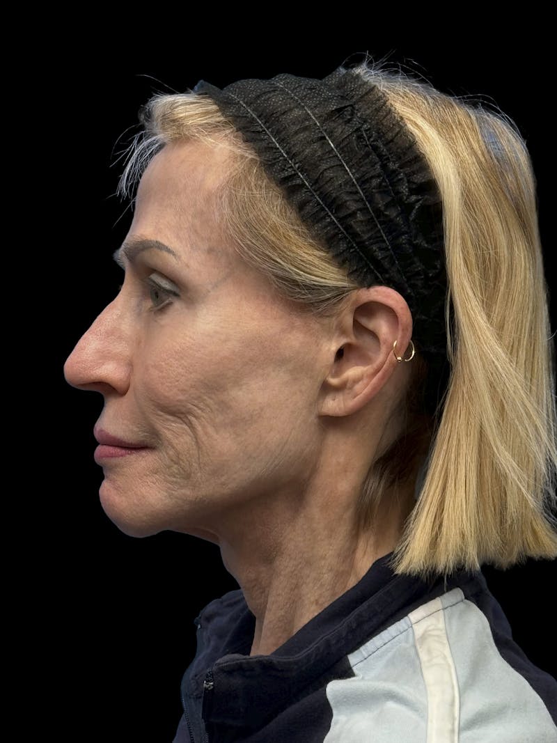 Revision Facelift Before & After Gallery - Patient 974023 - Image 7