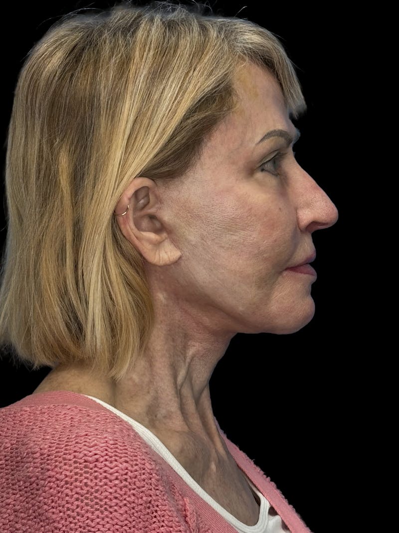 Revision Facelift Before & After Gallery - Patient 974023 - Image 10