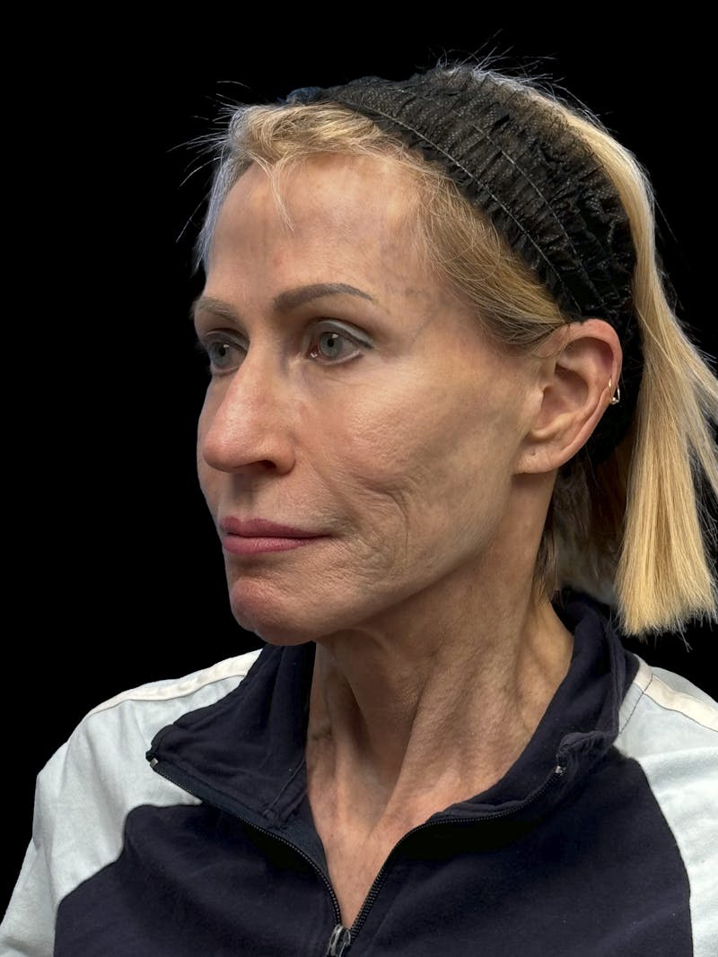 Revision Facelift Before & After Gallery - Patient 974023 - Image 3