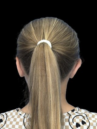 Otoplasty Before & After Gallery - Patient 346043 - Image 4